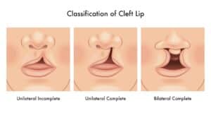 Cleft Lip and Cleft Palate